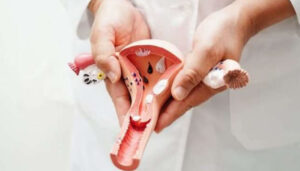 Citología es clave para disminuir el impacto del cáncer de cérvix, según especialistas